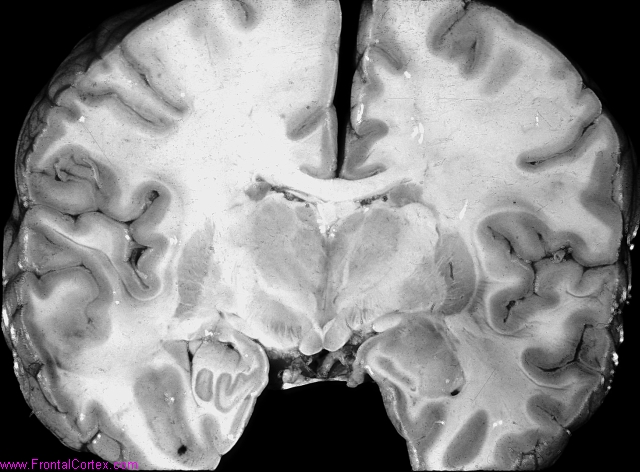 Diffuse cerebral edema in a patient with hypertensive encephalopathy